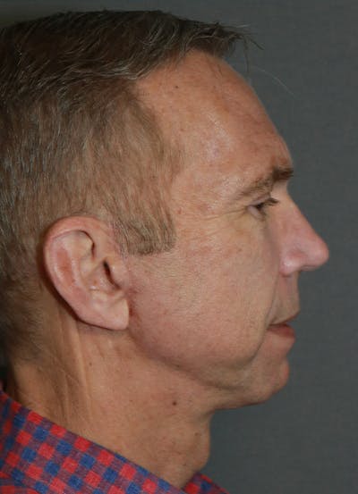 Facelift Before & After Gallery - Patient 48085512 - Image 6