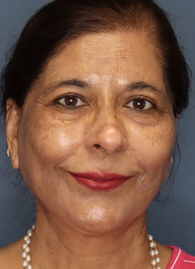 Facelift Before & After Gallery - Patient 48085513 - Image 2