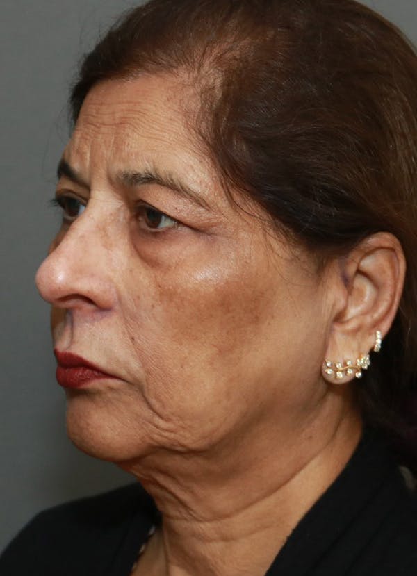 Facelift Before & After Gallery - Patient 48085513 - Image 3