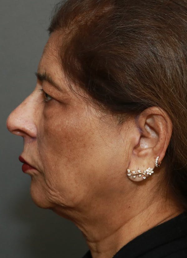 Facelift Before & After Gallery - Patient 48085513 - Image 5