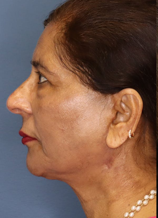 Facelift Before & After Gallery - Patient 48085513 - Image 6