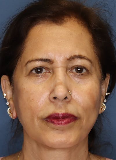 Facelift Before & After Gallery - Patient 48085514 - Image 2
