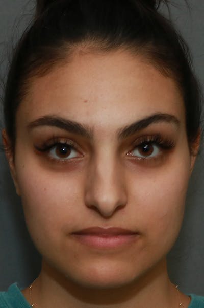 Aesthetic Rhinoplasty Before & After Gallery - Patient 48085874 - Image 1