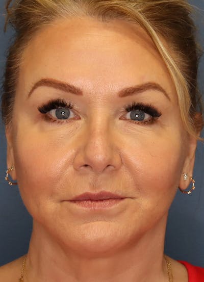 Facelift Before & After Gallery - Patient 63017706 - Image 2