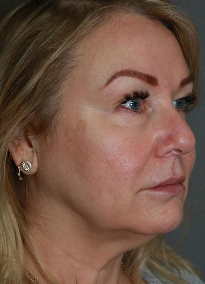 Facelift Before & After Gallery - Patient 63017706 - Image 4