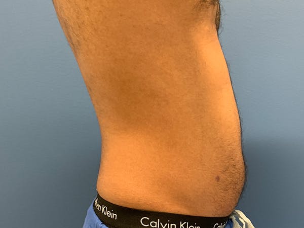 Cool Sculpting Before & After Gallery - Patient 51416736 - Image 5