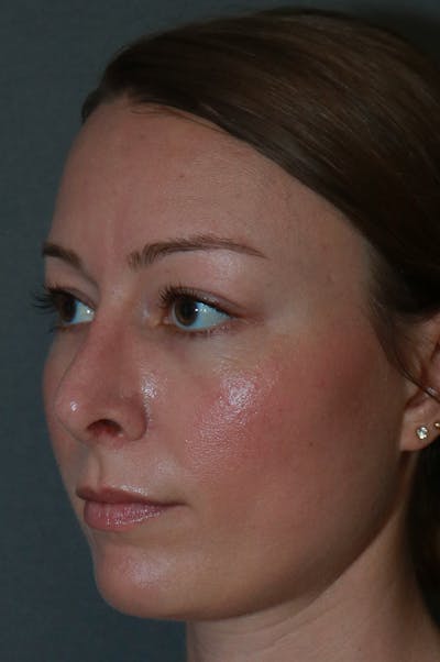 Aesthetic Rhinoplasty Before & After Gallery - Patient 53229901 - Image 2