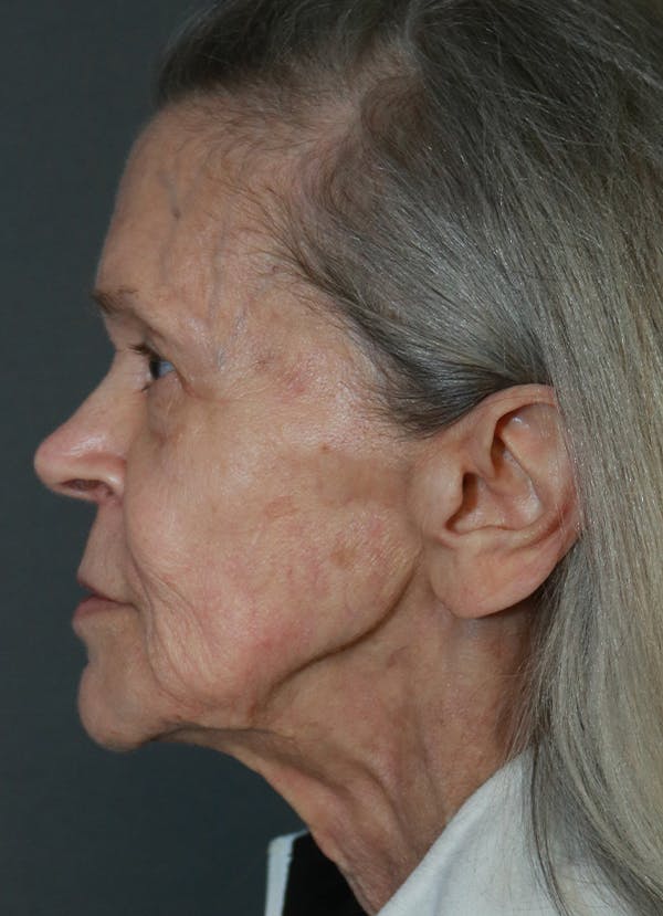 Facelift Before & After Gallery - Patient 53229953 - Image 5