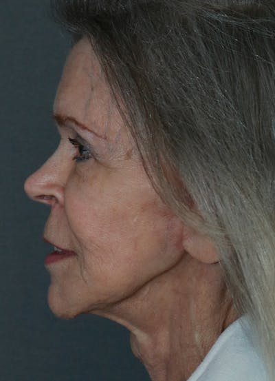 Facelift Before & After Gallery - Patient 53229953 - Image 6