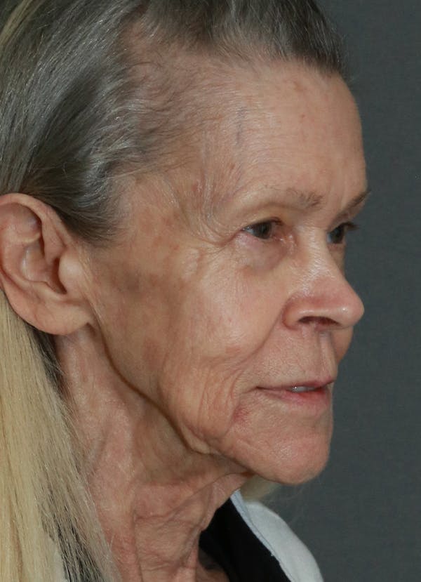 Facelift Before & After Gallery - Patient 53229953 - Image 7