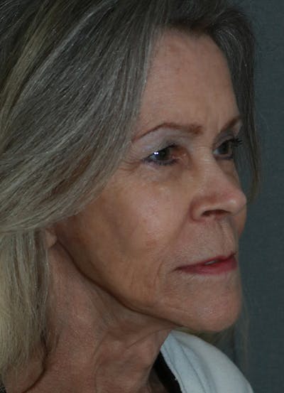Facelift Before & After Gallery - Patient 53229953 - Image 8