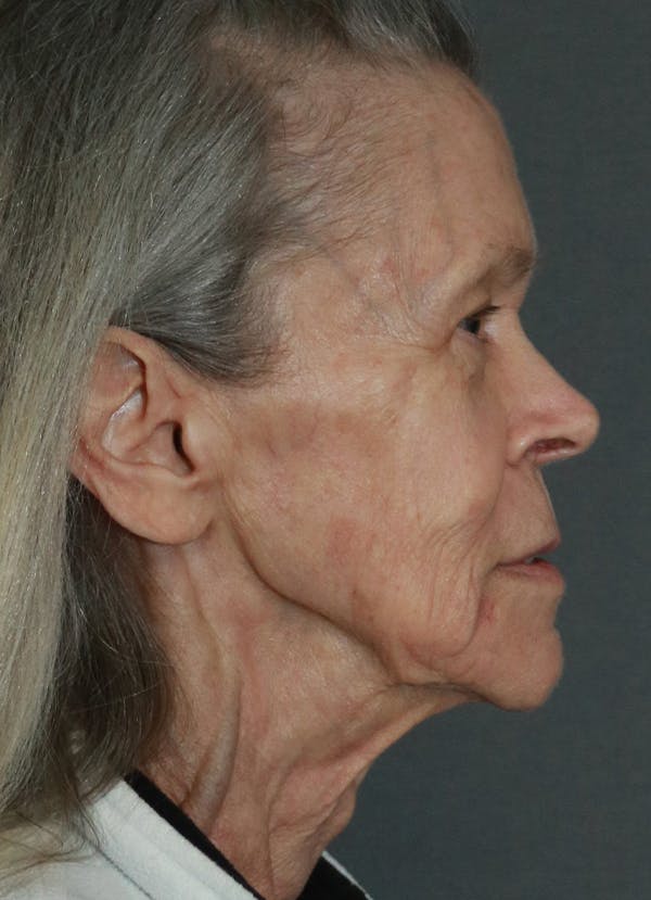 Facelift Before & After Gallery - Patient 53229953 - Image 9