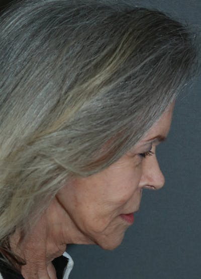 Facelift Before & After Gallery - Patient 53229953 - Image 12