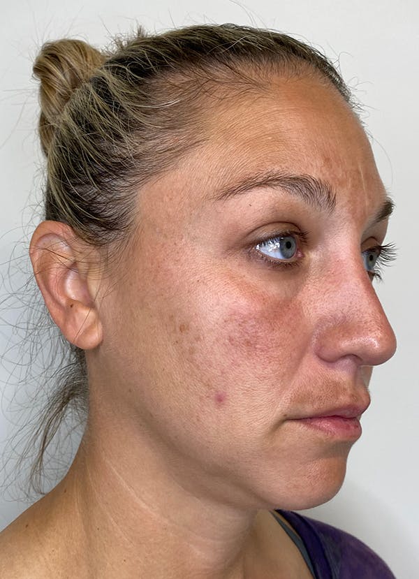 Chemical Peels Before & After Gallery - Patient 55281375 - Image 5