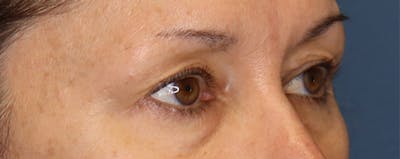 Upper Blepharoplasty Before & After Gallery - Patient 57584088 - Image 1