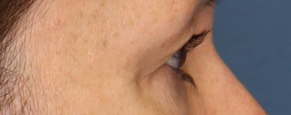 Upper Blepharoplasty Before & After Gallery - Patient 57584088 - Image 3