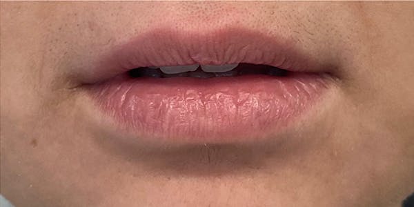 Lip Filler Before & After Gallery - Patient 61325632 - Image 1