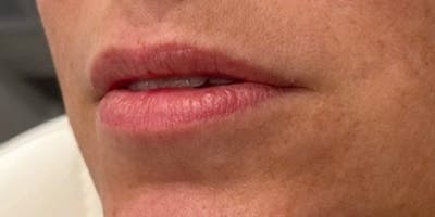 Lip Filler Before & After Gallery - Patient 61325633 - Image 1
