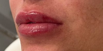 Lip Filler Before & After Gallery - Patient 61325633 - Image 2