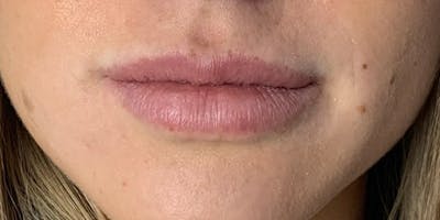 Lip Filler Before & After Gallery - Patient 61325627 - Image 1