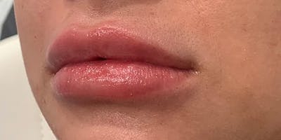 Lip Filler Before & After Gallery - Patient 61325634 - Image 2