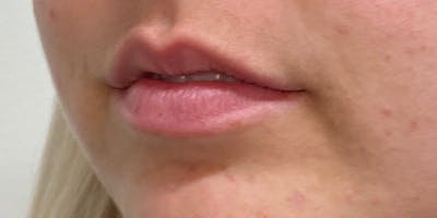 Lip Filler Before & After Gallery - Patient 61325628 - Image 1