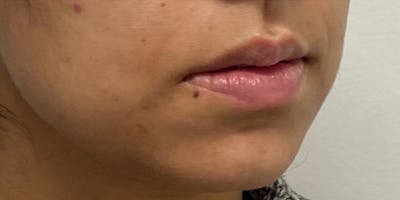 Lip Filler Before & After Gallery - Patient 61325626 - Image 1