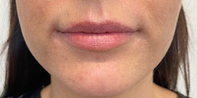 Lip Filler Before & After Gallery - Patient 61325622 - Image 1