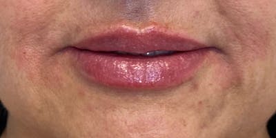 Lip Filler Before & After Gallery - Patient 61325631 - Image 2