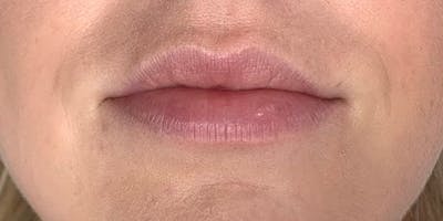 Lip Filler Before & After Gallery - Patient 61325635 - Image 1