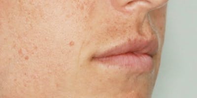 Lip Filler Before & After Gallery - Patient 61325630 - Image 1