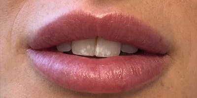 Lip Filler Before & After Gallery - Patient 61325636 - Image 2