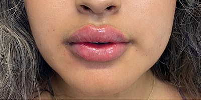 Lip Filler Before & After Gallery - Patient 61325621 - Image 2