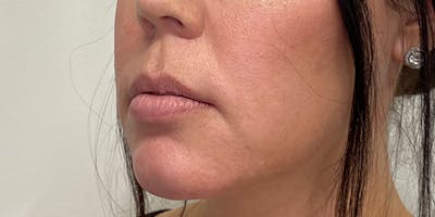 Lip Filler Before & After Gallery - Patient 61325623 - Image 1