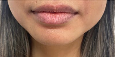 Lip Filler Before & After Gallery - Patient 61325625 - Image 1