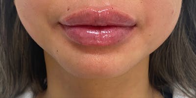 Lip Filler Before & After Gallery - Patient 61325625 - Image 2