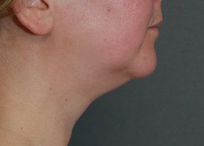 Double Chin (Submental Liposuction) Before & After Gallery - Patient 84619444 - Image 1