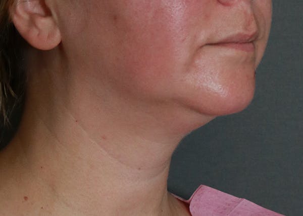 Double Chin (Submental Liposuction) Before & After Gallery - Patient 84619444 - Image 3
