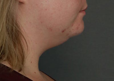 Double Chin (Submental Liposuction) Before & After Gallery - Patient 84619066 - Image 1
