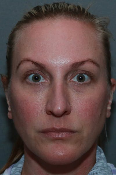 Revision Rhinoplasty Before & After Gallery - Patient 75543196 - Image 1