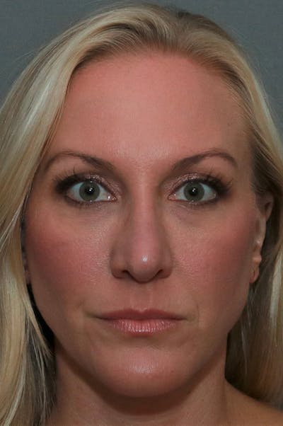 Revision Rhinoplasty Before & After Gallery - Patient 75543196 - Image 2