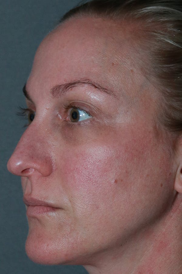 Revision Rhinoplasty Before & After Gallery - Patient 75543196 - Image 3