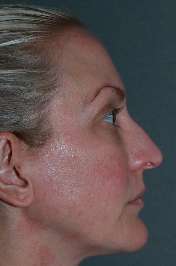 Revision Rhinoplasty Before & After Gallery - Patient 75543196 - Image 5