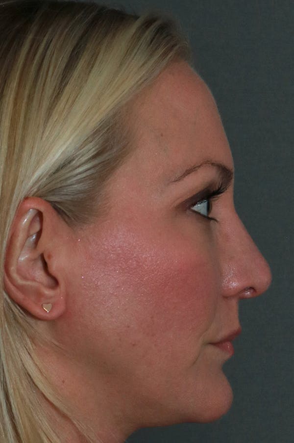 Revision Rhinoplasty Before & After Gallery - Patient 75543196 - Image 6