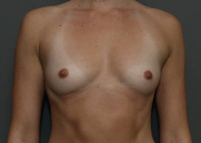 Breast Augmentation Before & After Gallery - Patient 94080429 - Image 1