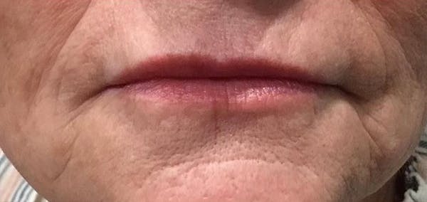 Lip Filler Before & After Gallery - Patient 99750492 - Image 2