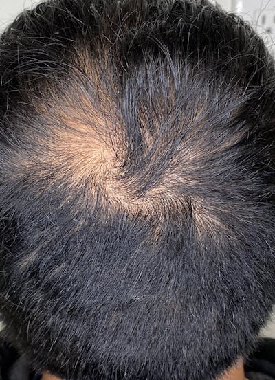 Keravive Scalp Treatment Before & After Gallery - Patient 107320952 - Image 1
