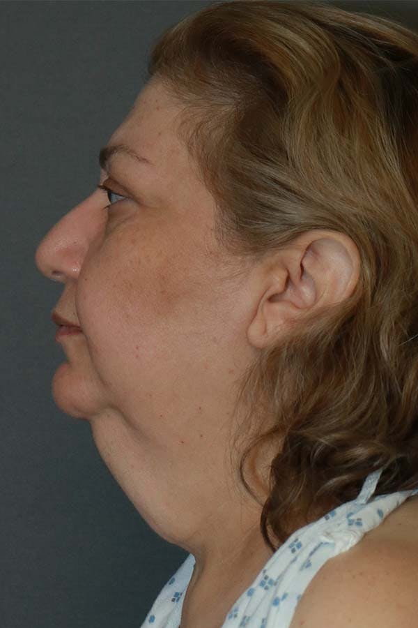 Facelift Before & After Gallery - Patient 121724324 - Image 3