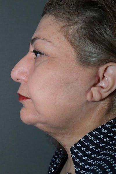 Facelift Before & After Gallery - Patient 121724324 - Image 4