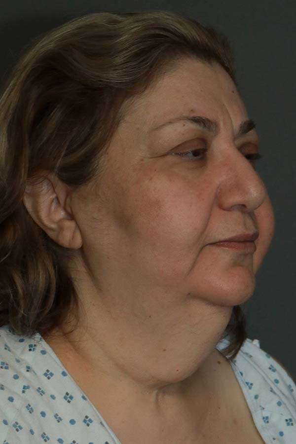 Facelift Before & After Gallery - Patient 121724324 - Image 5